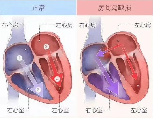 又能跳舞了”64 岁阿姨胸闷气短 8 个月，心脏里多了个“洞”，空港亚心医院微创补心让患者重新起舞