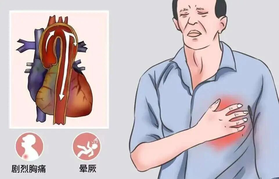 主动脉夹层：身体内的“血管撕裂”危机