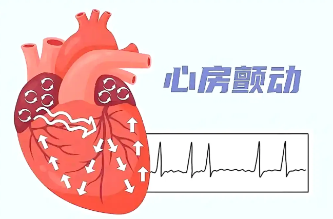 心跳乱了，警惕中风风险！房颤患者必看的中风预防指南